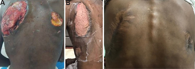 (A) Extensive vasculitic ulcers over the back. (B) Biological dressing using allograft from father covering the larger ulcer. (C) Healed ulcers at follow up after immunosuppressive therapy.